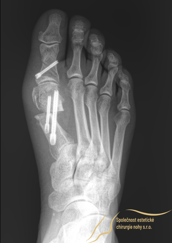 pooperační rentgenový snímek vbočeného palce